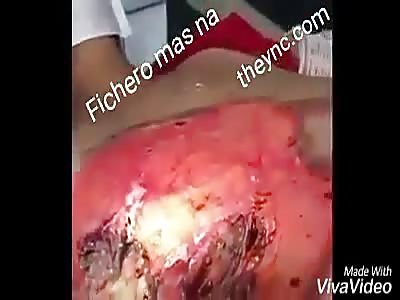 Worm-infected wound (shocking)