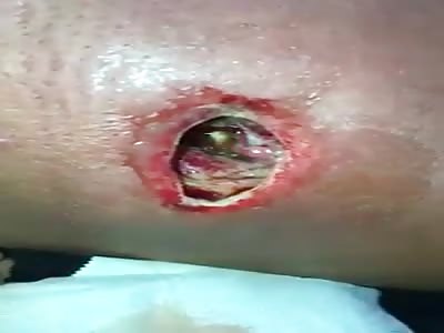 Thief gets into the jungle after a shot, when they found his wound was infected with worms  (1)