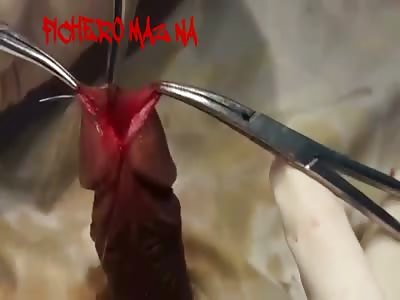 Man gets painful surgery to enlarge his penis