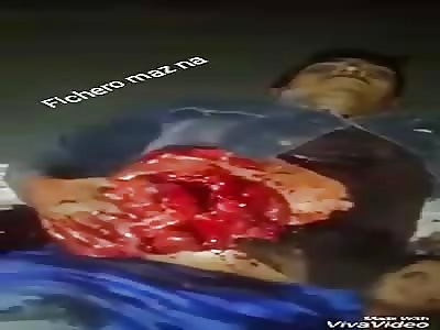 INCREDIBLE: man suffers accident and remains with the viscera from outside and still lives