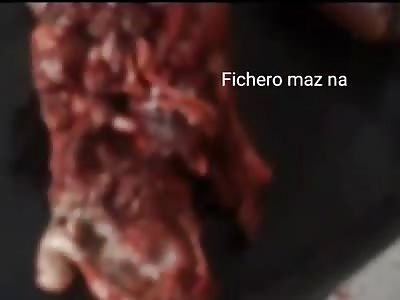 MAN LOSES THE FEET AND SAVES FOR SHOES