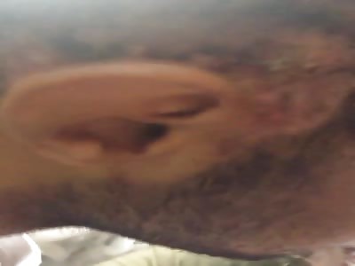 SEQUENCES OF ACCIDENT IN THE HEAD OF MAN