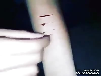 BEAUTIFUL CUTS IN ARM