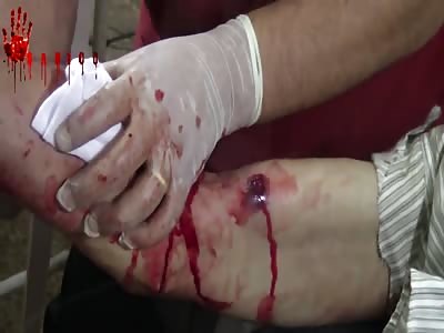 WTF WOUND IN THE ARM