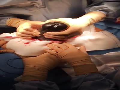 Enormous Dildo Surgically Removed Using Small Incision in Stomach