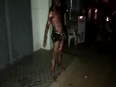 Man Walking Around With Body Totally Burned 