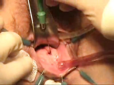 gyno repair rectovaginal real video shock