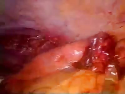 Gunshot Wound to the Abdomen Laparoscopic Exploration and Repair of Small Bowel Injury