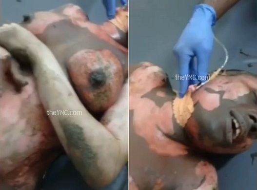Husband Provokes 3rd Degree Burns on his Wife’s Tits