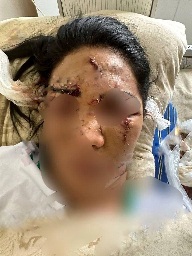 Uzbekistanian hit woman with glass bottle caused her a 40 stitch 