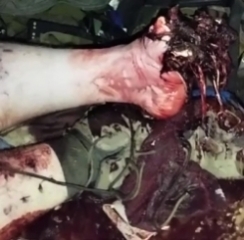 UA POV: UAF medic works on the mangled foot of a fellow soldier