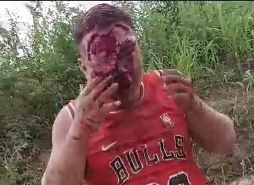 Face Skin Peeled In Motorcycle Accident