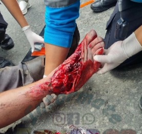 [Slide show] HORRIFIC ACCIDENT LEAVES MAN WITH CRUSHED LEGS 
