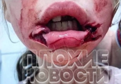 (Action & Aftermath) Stray Dog ​​Attacked and Tore Lip of a Gril who Tried to Pet Him. 