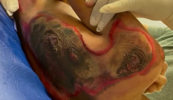 Horrific burned skin wounds on worker victim of electricity accident 