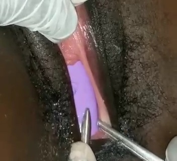 [Painful]Removing plastic cup used as a dildo stuck in woman vagina 
