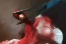 Extracting bullet from girl shoulder 