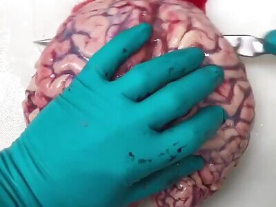 Brain autopsy