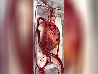 Heart Valve Surgery' organ before a heart transplant 