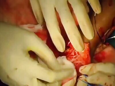 The Process of Reattaching Patient's Hand that Have Been Severed 