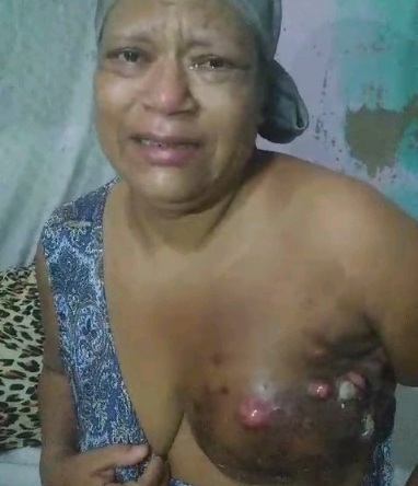 Brazilian woman with a horrific Breast cancer asking for HELP 