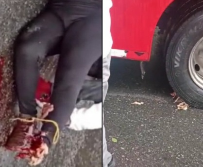 Shattred leg of female motorcyclist crashed under bus