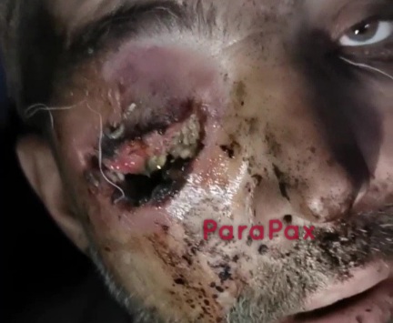 Russian soldier showing his rotten eye full of maggots 