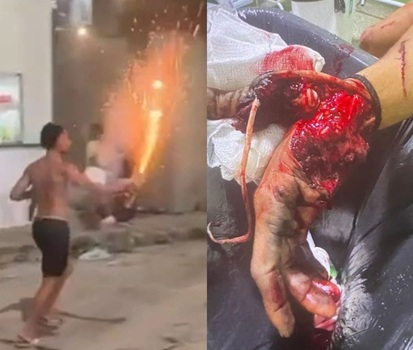 Drunk Genius Loses Hand In Fireworks Failure