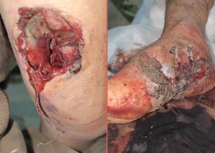 [MAGGOTS]RUSSIAN WOUNDED SOLDIER WITH A VERY ROTTEN LEG 