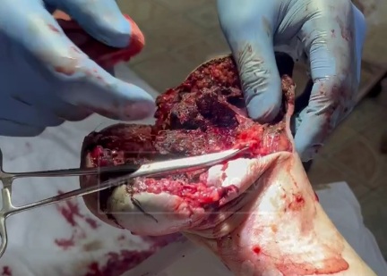 Wounded Russian soldier after stepping on a landmine 