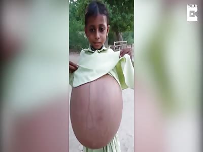 Nine Year Old's Stomach Size Of A Beach Ball