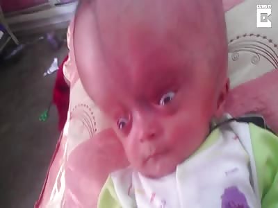 Baby's Head Swells Up Like Football