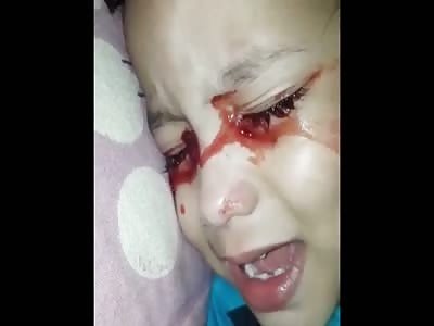 Mysterious condition that causes toddler to cry tears of BLOOD