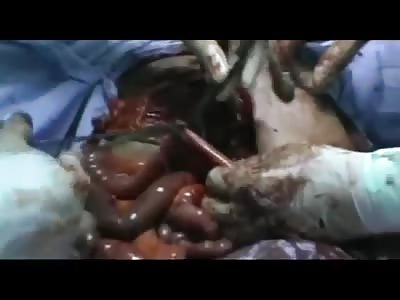 surgery for an injury in his stomach 