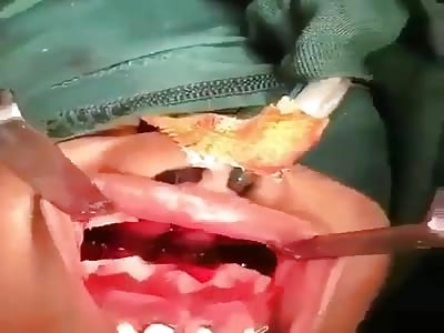 Upper jaw fracture