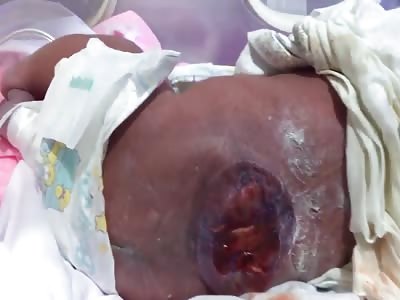 poor baby born with spina bifida and meningocele