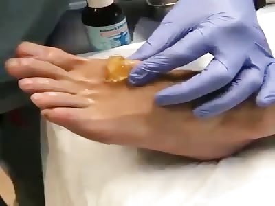 Ganglion cyst of the foot being drained out!!