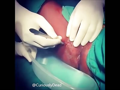 Draining Perianal Abcess (Abcess located by the Asshole)