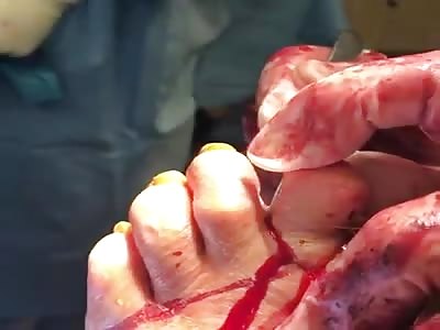 Cutting infected toe