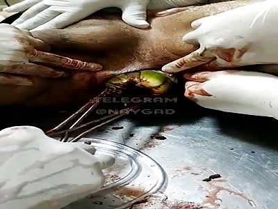 Doctor Extracting a coconut stuck in gay ass 