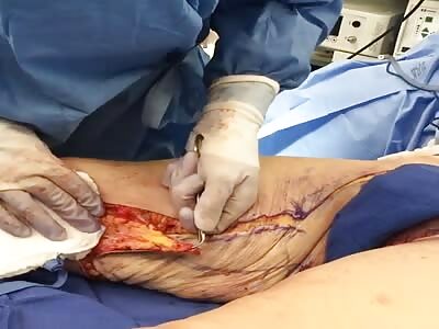 Removing huge piece of flesh from fat woman body during surgery 