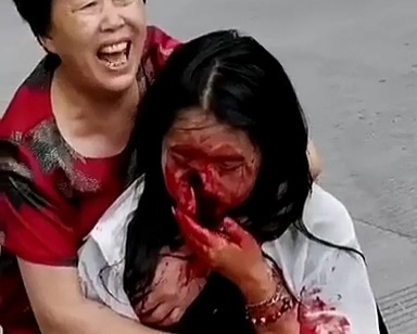 Chinese girl face split in half after a motorcycle accident 