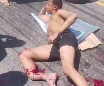 Motorcyclist crashed his leg after a horrific crash 