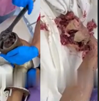 Hand Destroyed By Meat Grinder