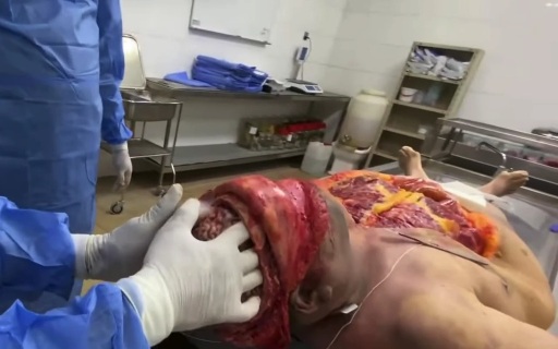 [AUTOPSY] BRAIN REMOVING AND EXAMINATION 