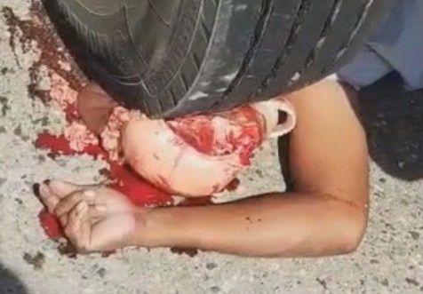 Man Scalped And Skinned By The Truck Wheel 