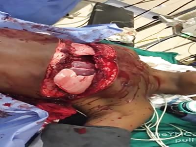 WTF!! Man With Severe Open Chest Trauma at ER