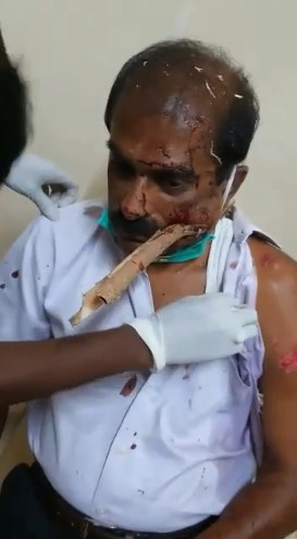 Work Accident Leaves A Man Disfigured After Taking A Tree Branch To The Face