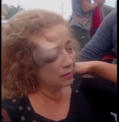 WOMAN FACE DEFORMED AFTER RUN OVER