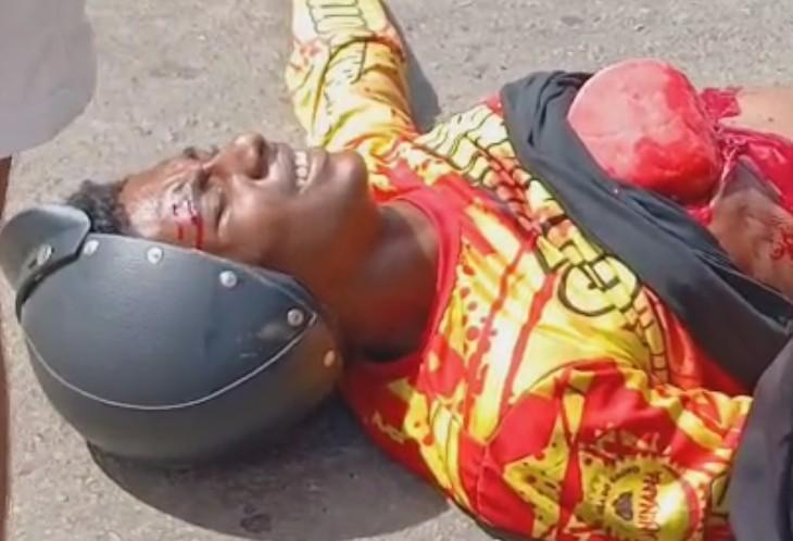 Brazilian Motorcyclist Left With Lung Exposed After Fender Bender